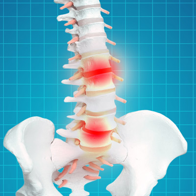 Low Back Pain